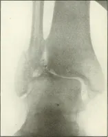An illustration from Gunshot Roentgenograms : Acollection of Roentgenograms taken in Constantinople during the Turko-Balkan War, 1912-1913, illustrating some gunshot wounds in the Turkish Army (1916)