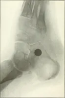 An illustration from Gunshot Roentgenograms : Acollection of Roentgenograms taken in Constantinople during the Turko-Balkan War, 1912-1913, illustrating some gunshot wounds in the Turkish Army (1916)