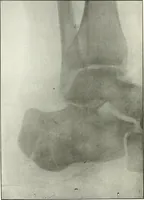 An illustration from Gunshot Roentgenograms : Acollection of Roentgenograms taken in Constantinople during the Turko-Balkan War, 1912-1913, illustrating some gunshot wounds in the Turkish Army (1916)