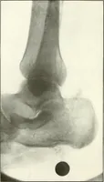 An illustration from Gunshot Roentgenograms : Acollection of Roentgenograms taken in Constantinople during the Turko-Balkan War, 1912-1913, illustrating some gunshot wounds in the Turkish Army (1916)