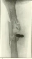 An illustration from Gunshot Roentgenograms : Acollection of Roentgenograms taken in Constantinople during the Turko-Balkan War, 1912-1913, illustrating some gunshot wounds in the Turkish Army (1916)