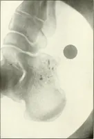 An illustration from Gunshot Roentgenograms : Acollection of Roentgenograms taken in Constantinople during the Turko-Balkan War, 1912-1913, illustrating some gunshot wounds in the Turkish Army (1916)