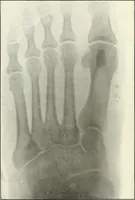 An illustration from Gunshot Roentgenograms : Acollection of Roentgenograms taken in Constantinople during the Turko-Balkan War, 1912-1913, illustrating some gunshot wounds in the Turkish Army (1916)