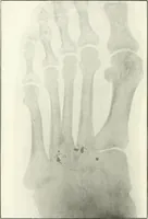 An illustration from Gunshot Roentgenograms : Acollection of Roentgenograms taken in Constantinople during the Turko-Balkan War, 1912-1913, illustrating some gunshot wounds in the Turkish Army (1916)
