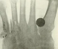 An illustration from Gunshot Roentgenograms : Acollection of Roentgenograms taken in Constantinople during the Turko-Balkan War, 1912-1913, illustrating some gunshot wounds in the Turkish Army (1916)
