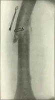 An illustration from Gunshot Roentgenograms : Acollection of Roentgenograms taken in Constantinople during the Turko-Balkan War, 1912-1913, illustrating some gunshot wounds in the Turkish Army (1916)