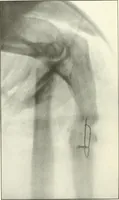 An illustration from Gunshot Roentgenograms : Acollection of Roentgenograms taken in Constantinople during the Turko-Balkan War, 1912-1913, illustrating some gunshot wounds in the Turkish Army (1916)
