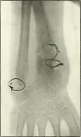 An illustration from Gunshot Roentgenograms : Acollection of Roentgenograms taken in Constantinople during the Turko-Balkan War, 1912-1913, illustrating some gunshot wounds in the Turkish Army (1916)