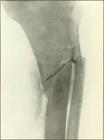 An illustration from Gunshot Roentgenograms : Acollection of Roentgenograms taken in Constantinople during the Turko-Balkan War, 1912-1913, illustrating some gunshot wounds in the Turkish Army (1916)