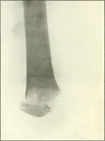 An illustration from Gunshot Roentgenograms : Acollection of Roentgenograms taken in Constantinople during the Turko-Balkan War, 1912-1913, illustrating some gunshot wounds in the Turkish Army (1916)