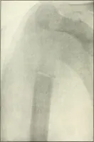 An illustration from Gunshot Roentgenograms : Acollection of Roentgenograms taken in Constantinople during the Turko-Balkan War, 1912-1913, illustrating some gunshot wounds in the Turkish Army (1916)