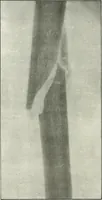 An illustration from Gunshot Roentgenograms : Acollection of Roentgenograms taken in Constantinople during the Turko-Balkan War, 1912-1913, illustrating some gunshot wounds in the Turkish Army (1916)