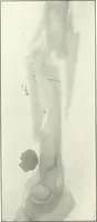 An illustration from Gunshot Roentgenograms : Acollection of Roentgenograms taken in Constantinople during the Turko-Balkan War, 1912-1913, illustrating some gunshot wounds in the Turkish Army (1916)