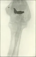 An illustration from Gunshot Roentgenograms : Acollection of Roentgenograms taken in Constantinople during the Turko-Balkan War, 1912-1913, illustrating some gunshot wounds in the Turkish Army (1916)