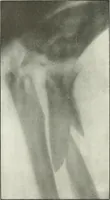 An illustration from Gunshot Roentgenograms : Acollection of Roentgenograms taken in Constantinople during the Turko-Balkan War, 1912-1913, illustrating some gunshot wounds in the Turkish Army (1916)
