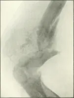 An illustration from Gunshot Roentgenograms : Acollection of Roentgenograms taken in Constantinople during the Turko-Balkan War, 1912-1913, illustrating some gunshot wounds in the Turkish Army (1916)