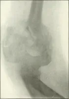 An illustration from Gunshot Roentgenograms : Acollection of Roentgenograms taken in Constantinople during the Turko-Balkan War, 1912-1913, illustrating some gunshot wounds in the Turkish Army (1916)