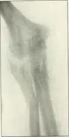 An illustration from Gunshot Roentgenograms : Acollection of Roentgenograms taken in Constantinople during the Turko-Balkan War, 1912-1913, illustrating some gunshot wounds in the Turkish Army (1916)