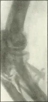 An illustration from Gunshot Roentgenograms : Acollection of Roentgenograms taken in Constantinople during the Turko-Balkan War, 1912-1913, illustrating some gunshot wounds in the Turkish Army (1916)