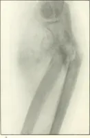 An illustration from Gunshot Roentgenograms : Acollection of Roentgenograms taken in Constantinople during the Turko-Balkan War, 1912-1913, illustrating some gunshot wounds in the Turkish Army (1916)