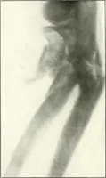 An illustration from Gunshot Roentgenograms : Acollection of Roentgenograms taken in Constantinople during the Turko-Balkan War, 1912-1913, illustrating some gunshot wounds in the Turkish Army (1916)