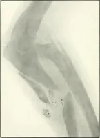 An illustration from Gunshot Roentgenograms : Acollection of Roentgenograms taken in Constantinople during the Turko-Balkan War, 1912-1913, illustrating some gunshot wounds in the Turkish Army (1916)