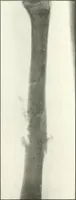 An illustration from Gunshot Roentgenograms : Acollection of Roentgenograms taken in Constantinople during the Turko-Balkan War, 1912-1913, illustrating some gunshot wounds in the Turkish Army (1916)