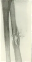 An illustration from Gunshot Roentgenograms : Acollection of Roentgenograms taken in Constantinople during the Turko-Balkan War, 1912-1913, illustrating some gunshot wounds in the Turkish Army (1916)