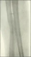 An illustration from Gunshot Roentgenograms : Acollection of Roentgenograms taken in Constantinople during the Turko-Balkan War, 1912-1913, illustrating some gunshot wounds in the Turkish Army (1916)