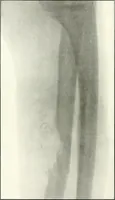 An illustration from Gunshot Roentgenograms : Acollection of Roentgenograms taken in Constantinople during the Turko-Balkan War, 1912-1913, illustrating some gunshot wounds in the Turkish Army (1916)