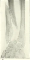 An illustration from Gunshot Roentgenograms : Acollection of Roentgenograms taken in Constantinople during the Turko-Balkan War, 1912-1913, illustrating some gunshot wounds in the Turkish Army (1916)