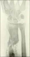 An illustration from Gunshot Roentgenograms : Acollection of Roentgenograms taken in Constantinople during the Turko-Balkan War, 1912-1913, illustrating some gunshot wounds in the Turkish Army (1916)