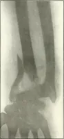 An illustration from Gunshot Roentgenograms : Acollection of Roentgenograms taken in Constantinople during the Turko-Balkan War, 1912-1913, illustrating some gunshot wounds in the Turkish Army (1916)