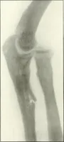 An illustration from Gunshot Roentgenograms : Acollection of Roentgenograms taken in Constantinople during the Turko-Balkan War, 1912-1913, illustrating some gunshot wounds in the Turkish Army (1916)