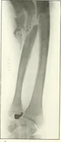 An illustration from Gunshot Roentgenograms : Acollection of Roentgenograms taken in Constantinople during the Turko-Balkan War, 1912-1913, illustrating some gunshot wounds in the Turkish Army (1916)