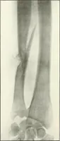 An illustration from Gunshot Roentgenograms : Acollection of Roentgenograms taken in Constantinople during the Turko-Balkan War, 1912-1913, illustrating some gunshot wounds in the Turkish Army (1916)