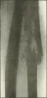 An illustration from Gunshot Roentgenograms : Acollection of Roentgenograms taken in Constantinople during the Turko-Balkan War, 1912-1913, illustrating some gunshot wounds in the Turkish Army (1916)