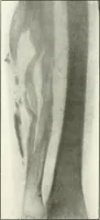 An illustration from Gunshot Roentgenograms : Acollection of Roentgenograms taken in Constantinople during the Turko-Balkan War, 1912-1913, illustrating some gunshot wounds in the Turkish Army (1916)