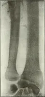 An illustration from Gunshot Roentgenograms : Acollection of Roentgenograms taken in Constantinople during the Turko-Balkan War, 1912-1913, illustrating some gunshot wounds in the Turkish Army (1916)
