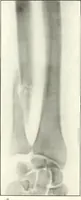 An illustration from Gunshot Roentgenograms : Acollection of Roentgenograms taken in Constantinople during the Turko-Balkan War, 1912-1913, illustrating some gunshot wounds in the Turkish Army (1916)