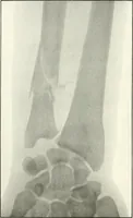 Picture 38 of 146 from Gunshot Roentgenograms : Acollection of Roentgenograms taken in Constantinople during the Turko-Balkan War, 1912-1913, illustrating some gunshot wounds in the Turkish Army (1916), leaf 94