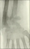 An illustration from Gunshot Roentgenograms : Acollection of Roentgenograms taken in Constantinople during the Turko-Balkan War, 1912-1913, illustrating some gunshot wounds in the Turkish Army (1916)