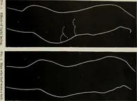 An illustration from The influence of dress in producing the physical decadence of American women : annual address upon obstetrics and gynecology (1891)