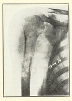 An illustration from The Journal of roentgenology (1918)
