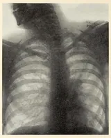 An illustration from The Journal of roentgenology (1918)