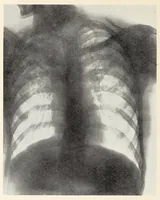 An illustration from The Journal of roentgenology (1918)