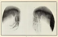 An illustration from The Journal of roentgenology (1918)