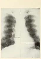 An illustration from The Journal of roentgenology (1918)