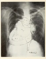 An illustration from The Journal of roentgenology (1918)