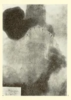 An illustration from The Journal of roentgenology (1918)